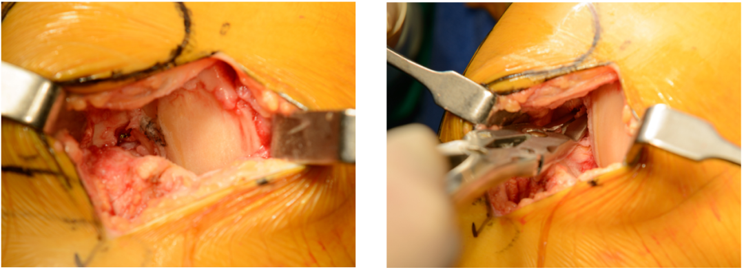【滑动垫片单髁置换技术精讲系列】第一讲：麻醉、体位