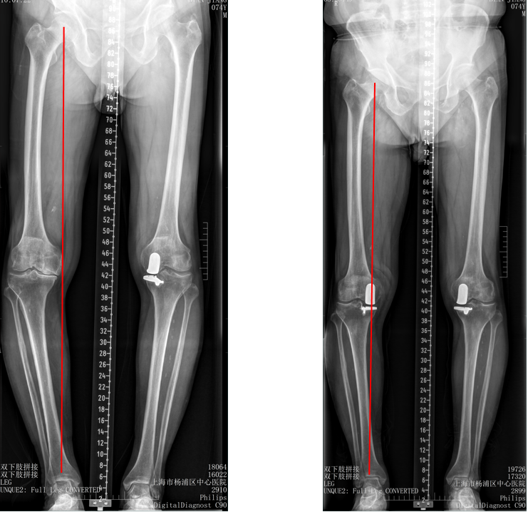 【读懂单髁】从读懂X-ray开始：固定平台单髁假体(LINK®