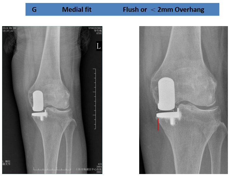 【读懂单髁】从读懂X-ray开始：胫骨假体位置解读