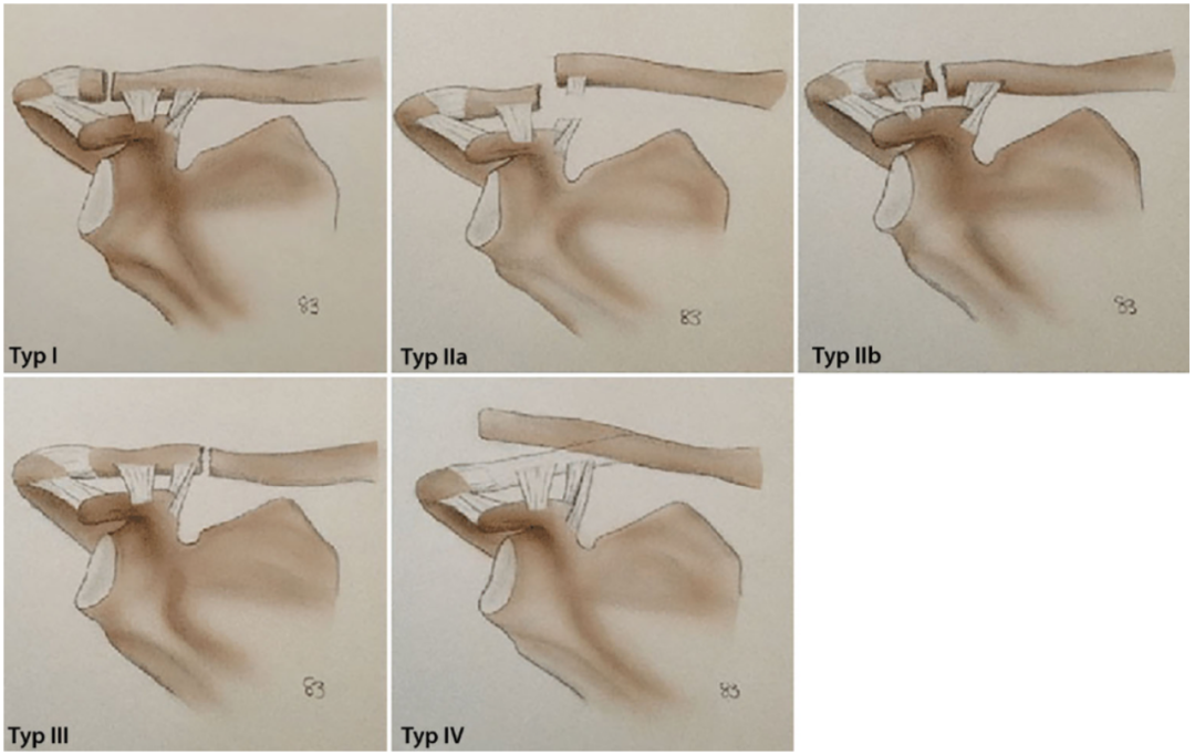 锁骨骨折：从分型到治疗的超全讲解，一文搞定！