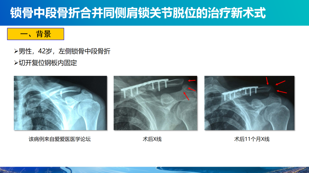 锁骨中段骨折合并同侧肩锁关节脱位新术式：弹性髓内钉+喙锁韧带重建、关节囊缝合