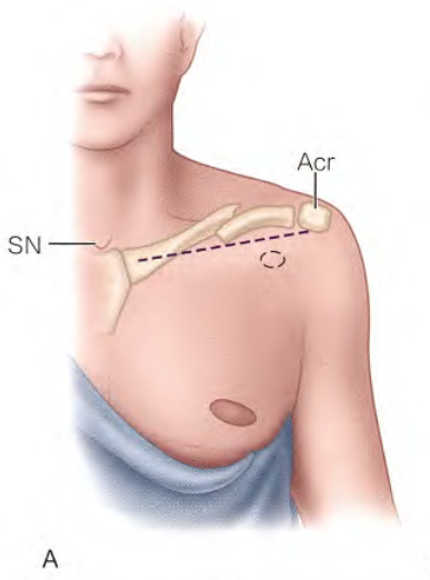 锁骨骨折：从分型到治疗的超全讲解，一文搞定！