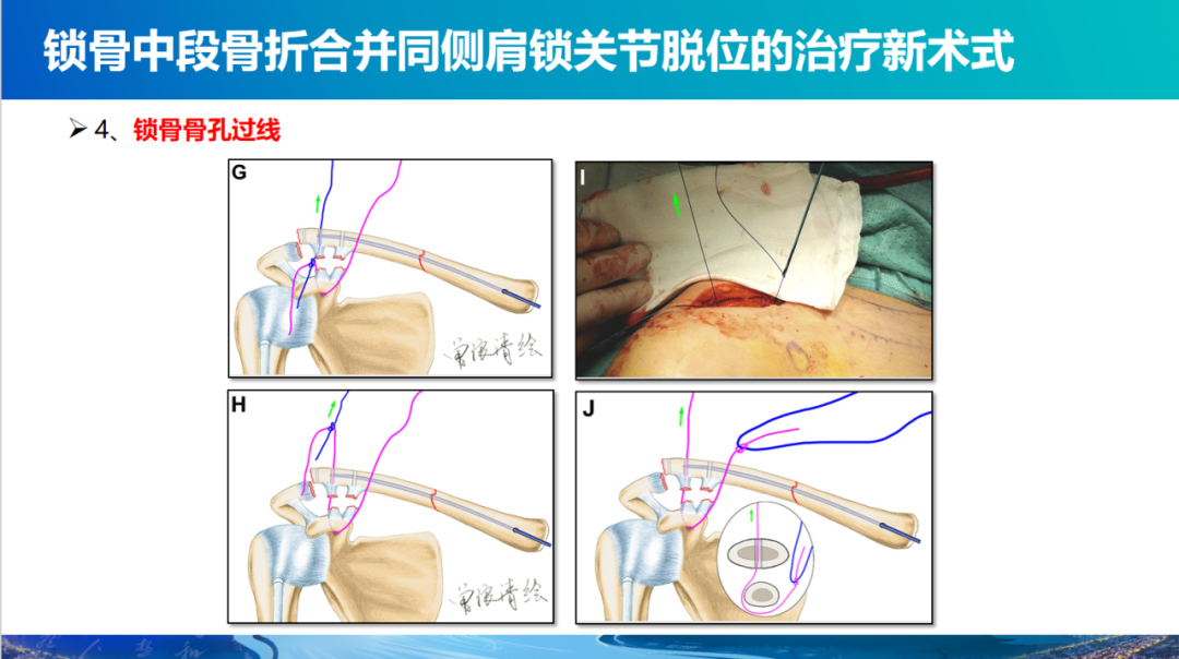 锁骨中段骨折合并同侧肩锁关节脱位新术式：弹性髓内钉+喙锁韧带重建、关节囊缝合