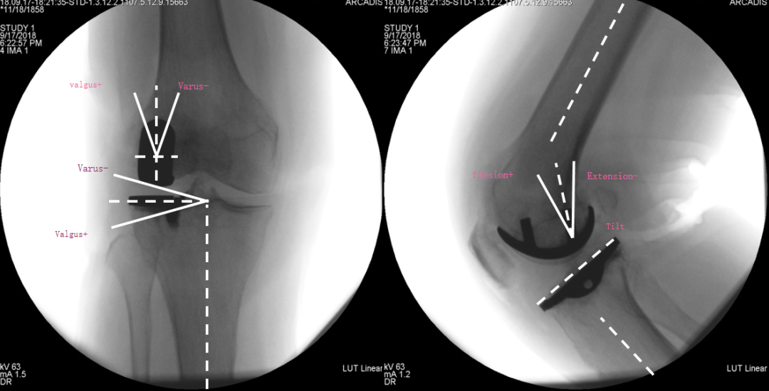 【读懂单髁】从读懂X-ray开始：固定平台单髁假体(LINK®