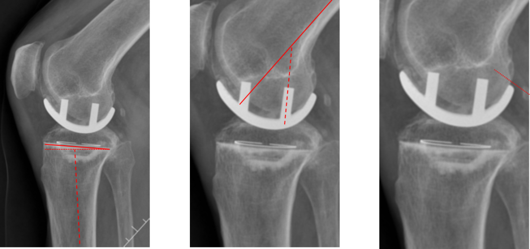 【读懂单髁】从读懂X-ray开始：固定平台单髁假体(LINK®