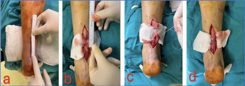 【手术技术】切开修复技术治疗急性跟腱断裂