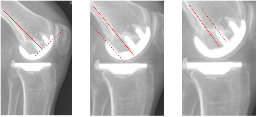 【读懂单髁】从读懂X-ray开始：固定平台单髁假体(SIGMA®