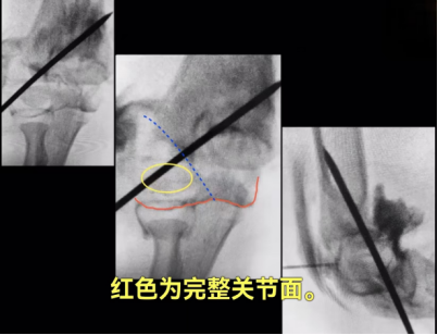 儿童肱骨外髁骨折的诊疗，本文全面总结！