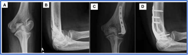 儿童肱骨外髁骨折的诊疗，本文全面总结！