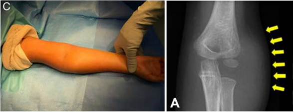 儿童肱骨外髁骨折的诊疗，本文全面总结！