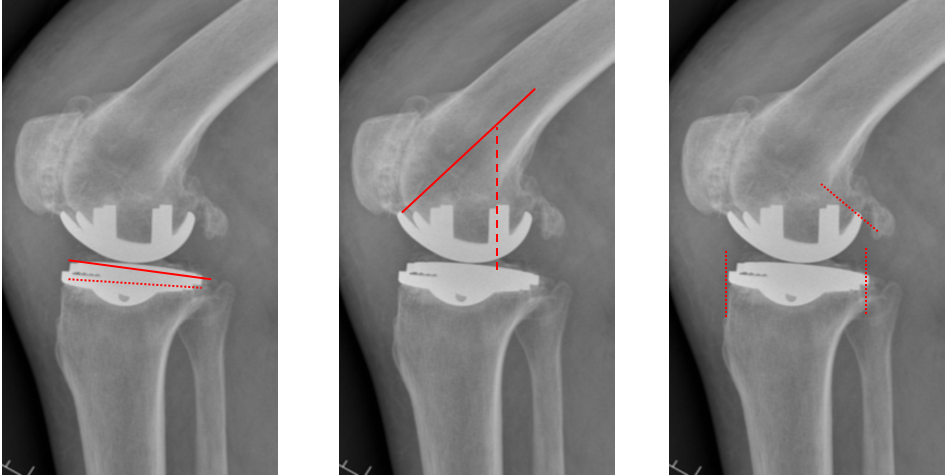 【读懂单髁】从读懂X-ray开始：固定平台单髁假体(LINK®
