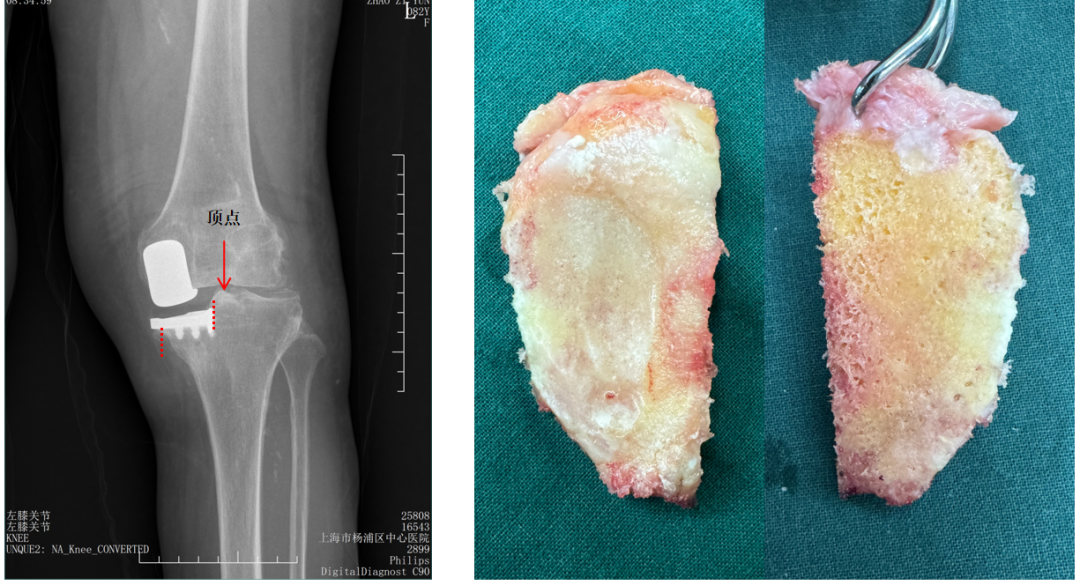 【读懂单髁】从读懂X-ray开始：胫骨假体位置解读