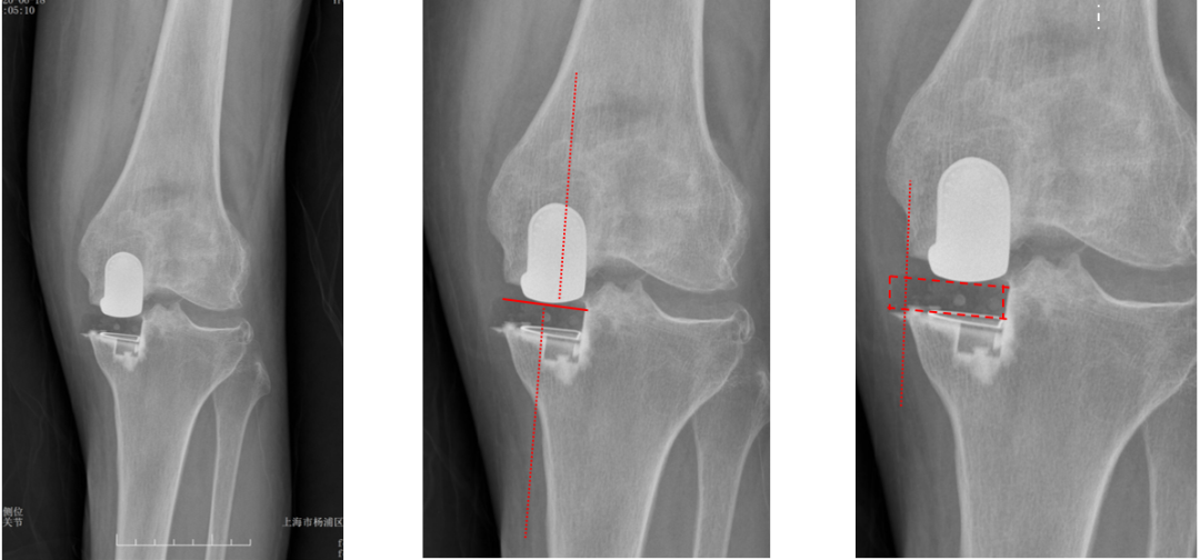 【读懂单髁】从读懂X-ray开始：固定平台单髁假体(LINK®