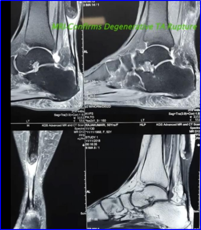 ​图文并茂：慢性跟腱断裂的最新治疗进展