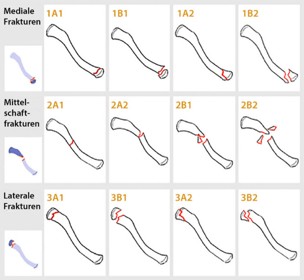 锁骨骨折：从分型到治疗的超全讲解，一文搞定！