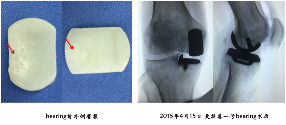 【读懂单髁】从读懂X-ray开始：术后摄片技术及垫片位置解读