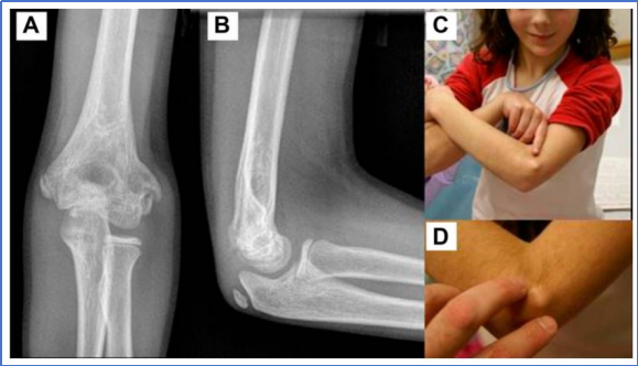 儿童肱骨外髁骨折的诊疗，本文全面总结！