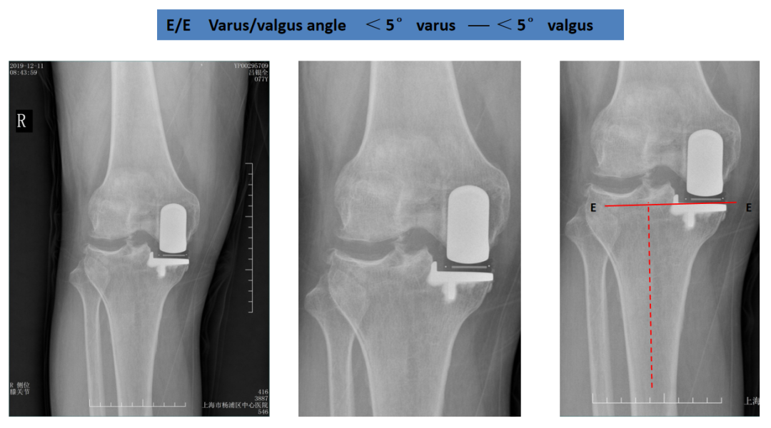 【读懂单髁】从读懂X-ray开始：胫骨假体位置解读