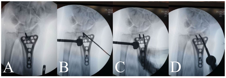 一文掌握，桡骨远端骨折微创钢板接骨术（MIPO），功能与美学效果双达标的安全技术！