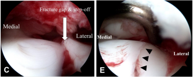 儿童肱骨外髁骨折的诊疗，本文全面总结！