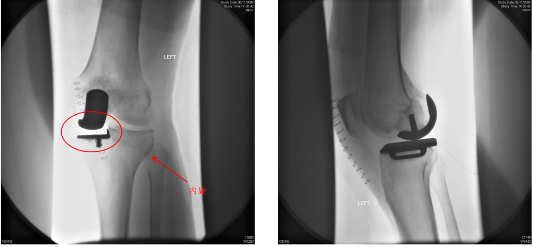 【读懂单髁】从读懂X-ray开始：胫骨假体位置解读