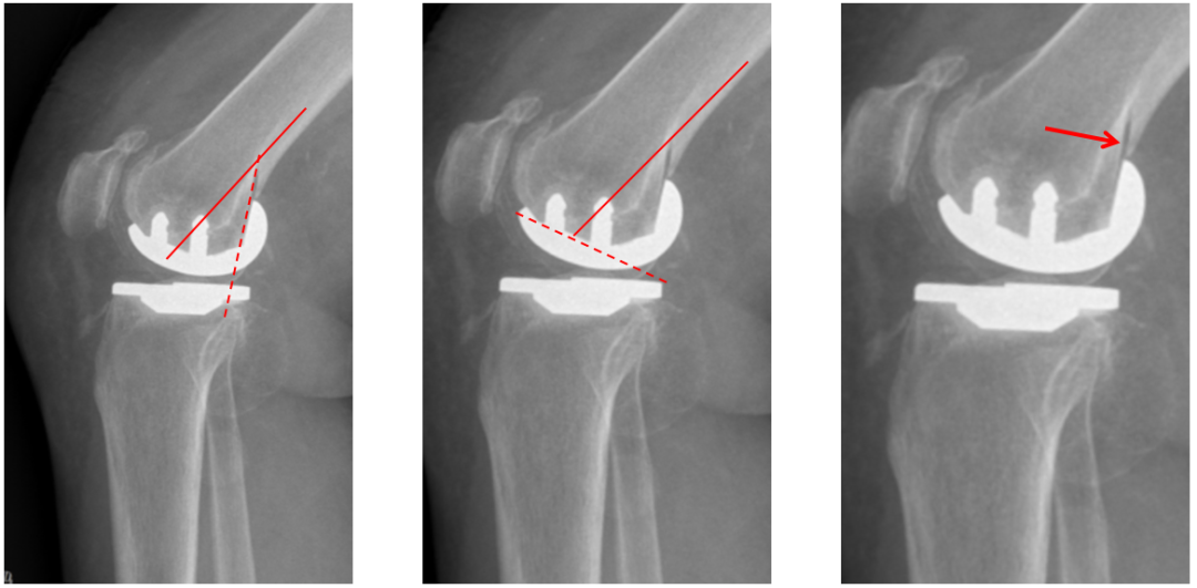 【读懂单髁】从读懂X-ray开始：固定平台单髁假体(SIGMA®