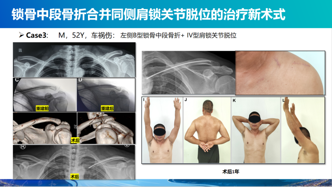 锁骨中段骨折合并同侧肩锁关节脱位新术式：弹性髓内钉+喙锁韧带重建、关节囊缝合