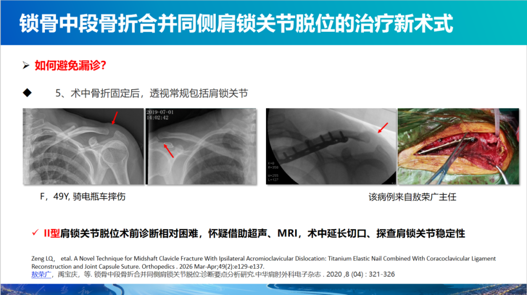 锁骨中段骨折合并同侧肩锁关节脱位新术式：弹性髓内钉+喙锁韧带重建、关节囊缝合