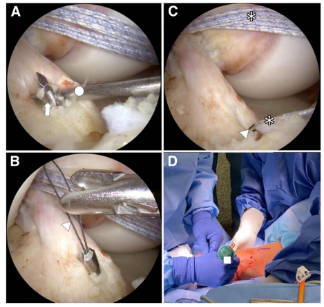图文详解关节镜下如何实现对前交叉韧带近端撕裂的精准修复