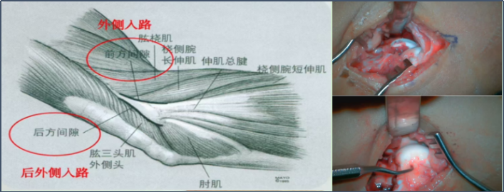 儿童肱骨外髁骨折的诊疗，本文全面总结！