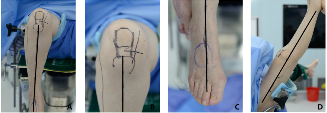 【滑动垫片单髁置换技术精讲系列】第一讲：麻醉、体位