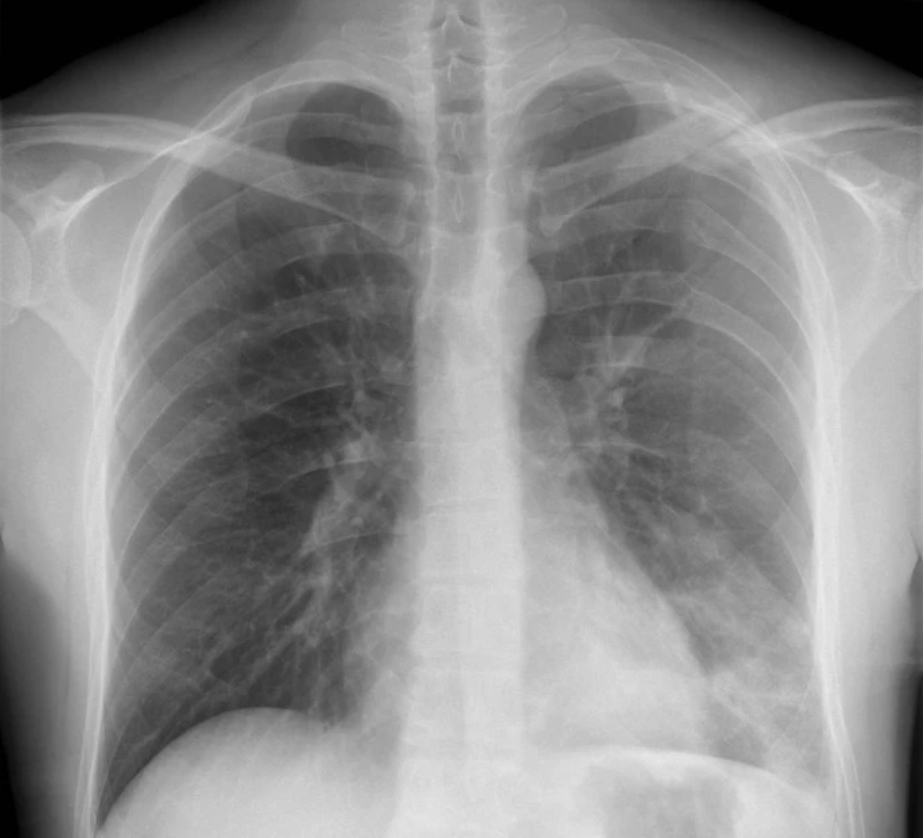 锁骨骨折：从分型到治疗的超全讲解，一文搞定！