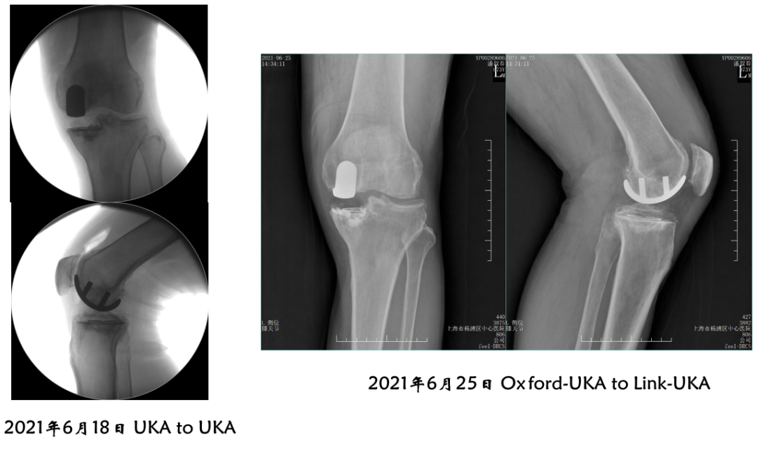 【读懂单髁】从读懂X-ray开始：术后摄片技术及垫片位置解读