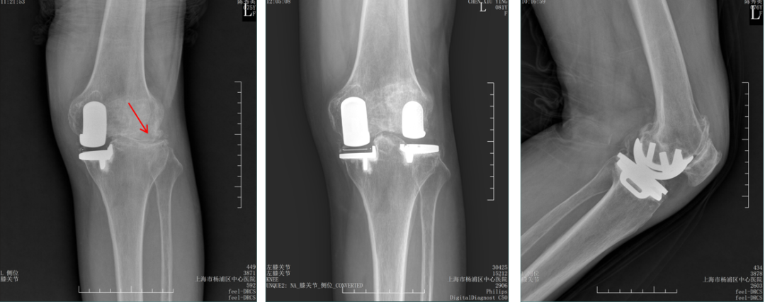 【读懂单髁】从读懂X-ray开始：固定平台单髁假体(LINK®