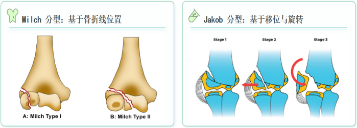 儿童肱骨外髁骨折的诊疗，本文全面总结！