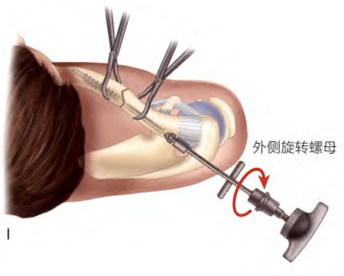 锁骨骨折：从分型到治疗的超全讲解，一文搞定！