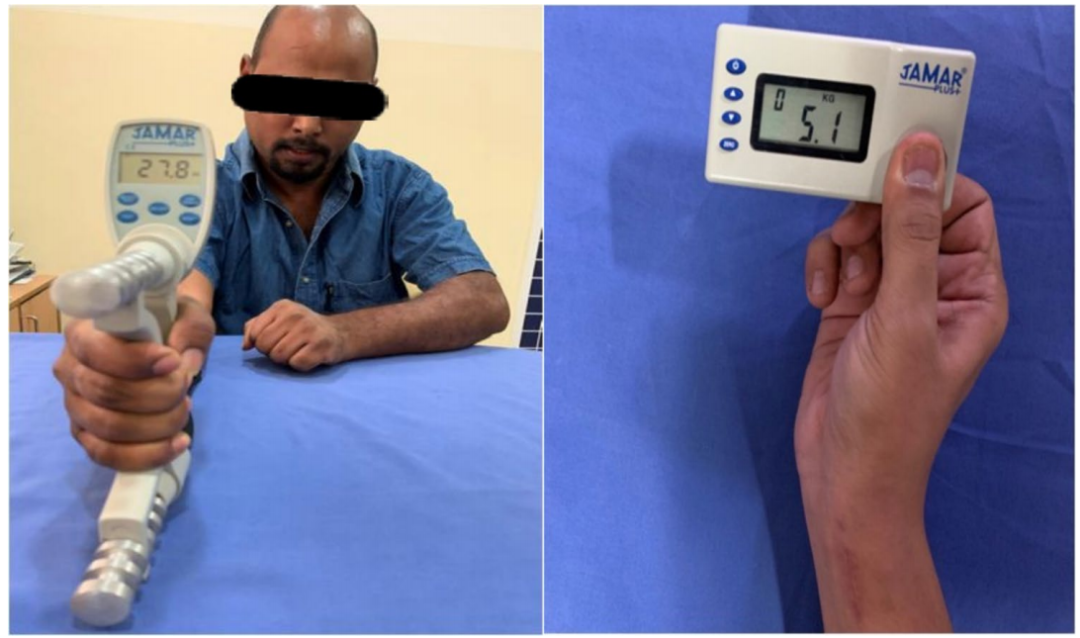 一文掌握，桡骨远端骨折微创钢板接骨术（MIPO），功能与美学效果双达标的安全技术！