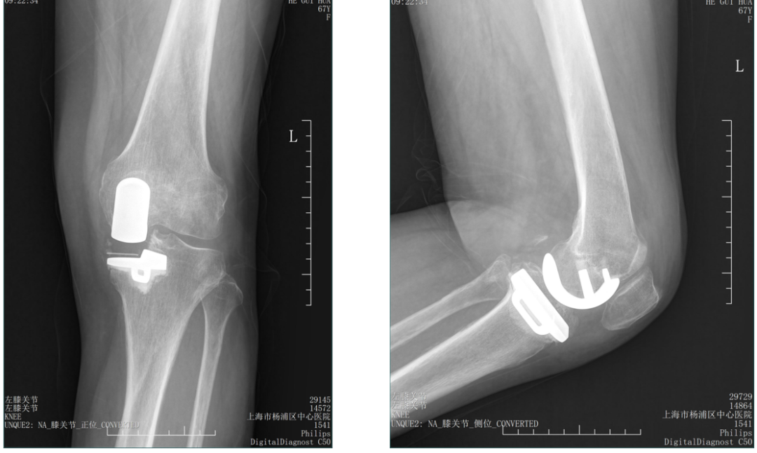 【读懂单髁】从读懂X-ray开始：胫骨假体位置解读