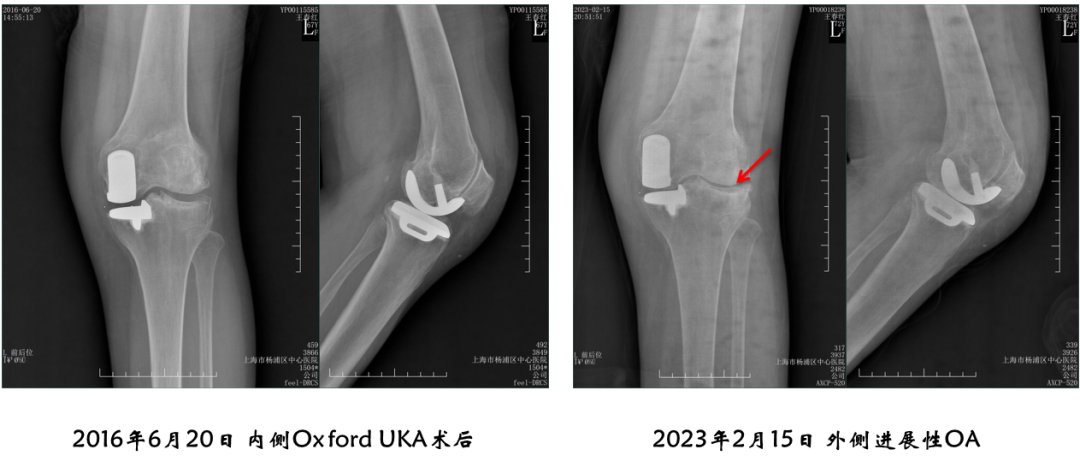 【读懂单髁】从读懂X-ray开始：术后摄片技术及垫片位置解读