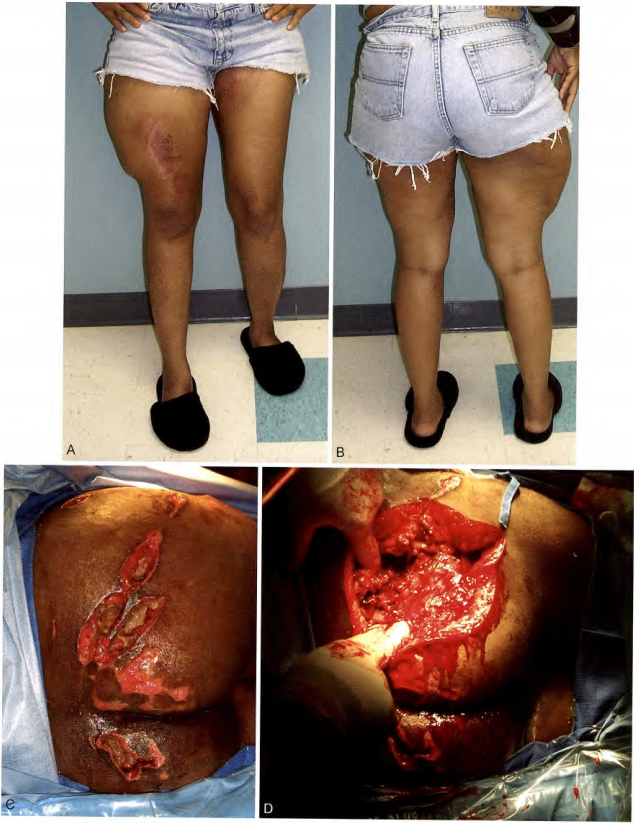 ​何时清创？如何减少感染？关于开放性骨折，你需要知道的方方面面！