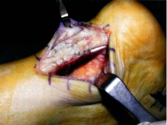 【手术技术】切开修复技术治疗急性跟腱断裂