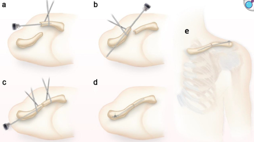 锁骨骨折：从分型到治疗的超全讲解，一文搞定！