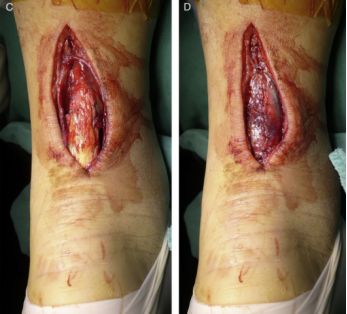 【手术技术】切开修复技术治疗急性跟腱断裂
