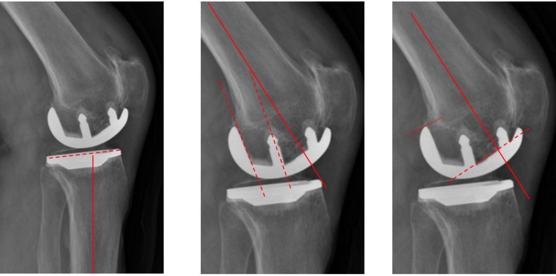 【读懂单髁】从读懂X-ray开始：固定平台单髁假体(SIGMA®