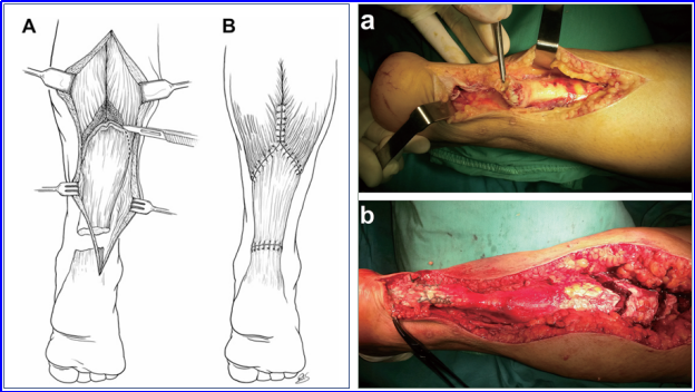 ​图文并茂：慢性跟腱断裂的最新治疗进展