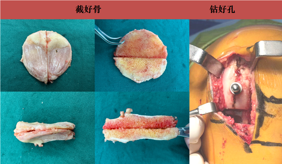 【滑动垫片单髁置换技术精讲系列】第四期：骨水泥固定