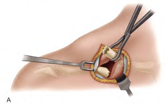 锁骨骨折：从分型到治疗的超全讲解，一文搞定！