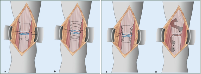 【手术技术】切开修复技术治疗急性跟腱断裂