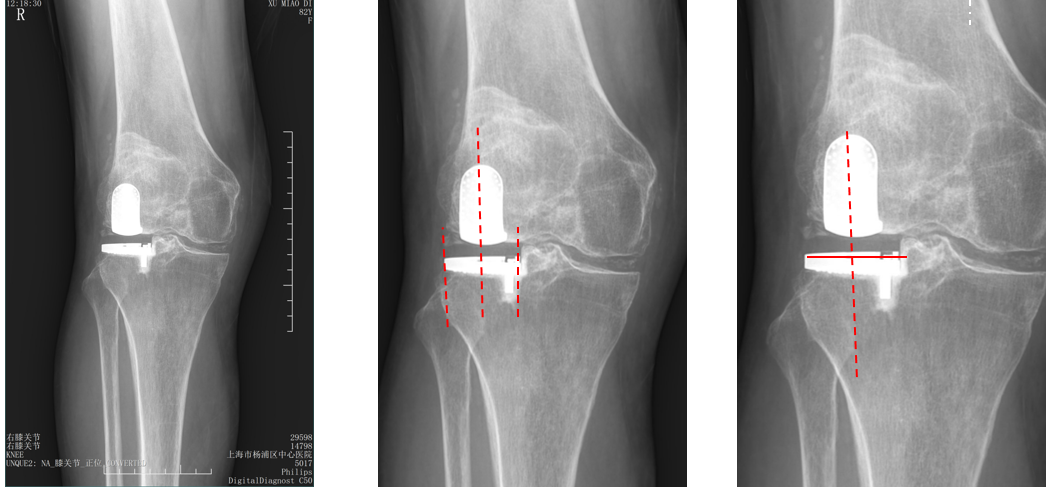 【读懂单髁】从读懂X-ray开始：固定平台单髁假体(LINK®