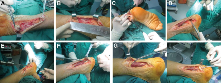 ​图文并茂：慢性跟腱断裂的最新治疗进展